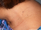 dermatosis papulosa nigra