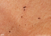dermatosis papulosa nigra