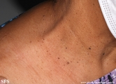 dermatosis papulosa nigra