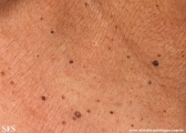 dermatosis papulosa nigra