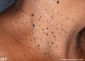 dermatosis papulosa nigra