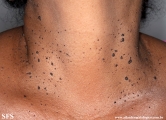 dermatosis papulosa nigra