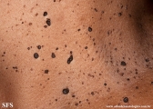 dermatosis papulosa nigra