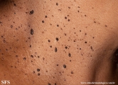dermatosis papulosa nigra