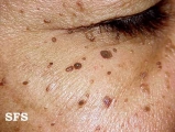 dermatosis papulosa nigra