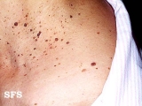 dermatosis papulosa nigra