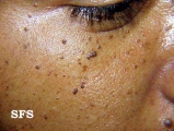 dermatosis papulosa nigra
