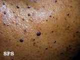 dermatosis papulosa nigra