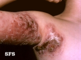 hodgkin's diseases