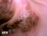 hodgkin's diseases