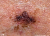 clear_cell_acanthoma_and_solar_lentigo