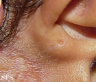 congenital auricular fistula