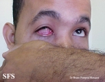 gonorrhea-gonococal conjunctivitis