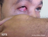 gonorrhea-gonococal conjunctivitis