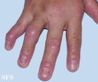 arthropathic psoriasis