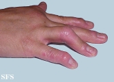 arthropathic psoriasis