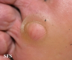 eccrine poroma