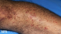 dermatitis herpetiformis