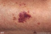 purpura senilis
