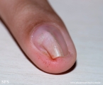 osteochondroma