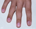 osteochondroma