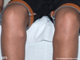 osteochondroma