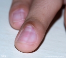 osteochondroma
