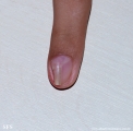 osteochondroma