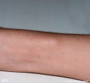 osteochondroma