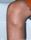 osteochondroma