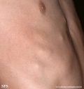 osteochondroma