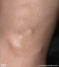 osteochondroma