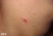 pityriasis lichenoides et varioliformis acuta