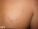 pityriasis lichenoides et varioliformis acuta
