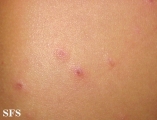 pityriasis lichenoides et varioliformis acuta