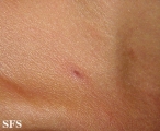 pityriasis lichenoides et varioliformis acuta