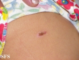 pityriasis lichenoides et varioliformis acuta