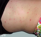 pityriasis lichenoides et varioliformis acuta