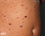 pityriasis lichenoides et varioliformis acuta