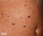 pityriasis lichenoides et varioliformis acuta