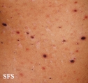 pityriasis lichenoides et varioliformis acuta