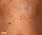 pityriasis lichenoides et varioliformis acuta