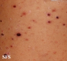 pityriasis lichenoides et varioliformis acuta