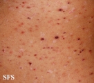 pityriasis lichenoides et varioliformis acuta
