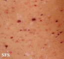 pityriasis lichenoides et varioliformis acuta
