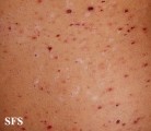 pityriasis lichenoides et varioliformis acuta