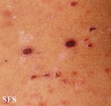 pityriasis lichenoides et varioliformis acuta