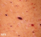 pityriasis lichenoides et varioliformis acuta