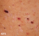 pityriasis lichenoides et varioliformis acuta