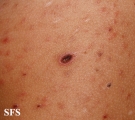 pityriasis lichenoides et varioliformis acuta